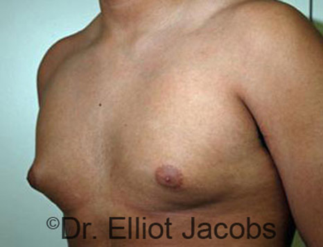 Men's breast, before Gynecomastia Adolescent treatment, oblique view - patient 21