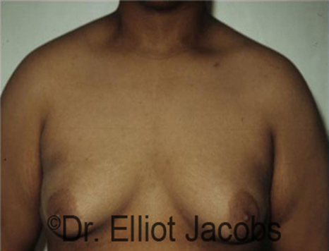 Men's breast, before Gynecomastia Adolescent treatment, front view - patient 22