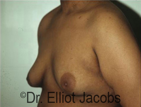 Men's breast, before Gynecomastia Adolescent treatment, oblique view - patient 22