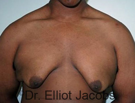 Men's breast, before Gynecomastia Adolescent treatment, front view - patient 23