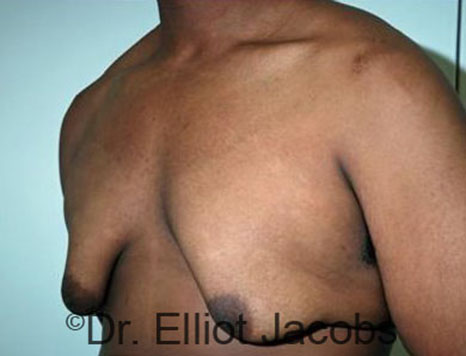 Men's breast, before Gynecomastia Adolescent treatment, oblique view - patient 23