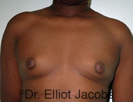 Men's breast, before Gynecomastia Adolescent treatment, front view - patient 24