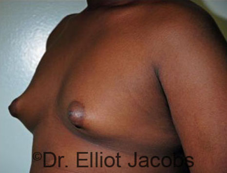 Men's breast, before Gynecomastia Adolescent treatment, oblique view - patient 24