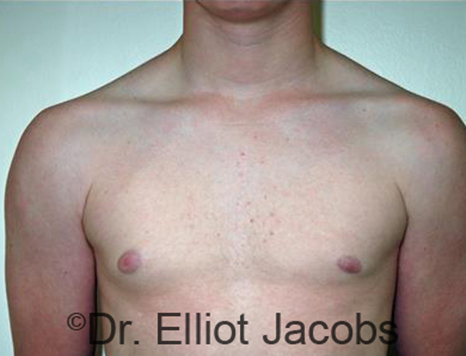 Men's breast, before Gynecomastia Adolescent treatment, front view - patient 25