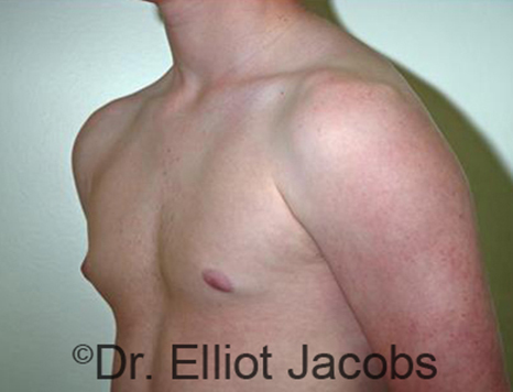 Men's breast, before Gynecomastia Adolescent treatment, oblique view - patient 25