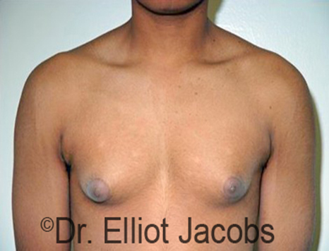 Men's breast, before Gynecomastia Adolescent treatment, front view - patient 26