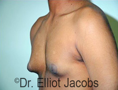 Men's breast, before Gynecomastia Adolescent treatment, oblique view - patient 26