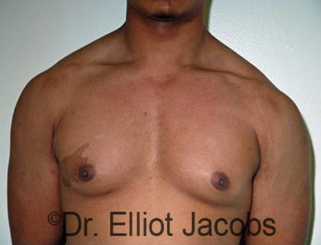 Men's breast, before Gynecomastia Adolescent treatment, front view - patient 27