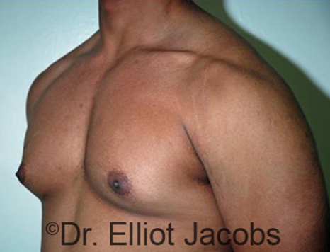 Men's breast, before Gynecomastia Adolescent treatment, oblique view - patient 27