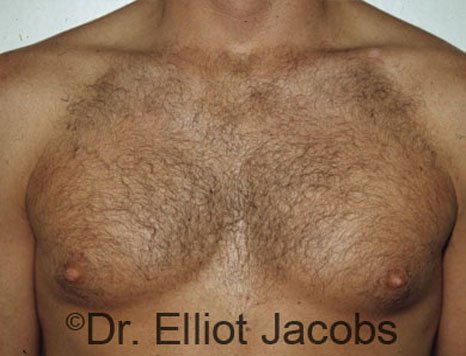 Men's breast, before Gynecomastia treatment in Bodybuilders, front view - patient 1