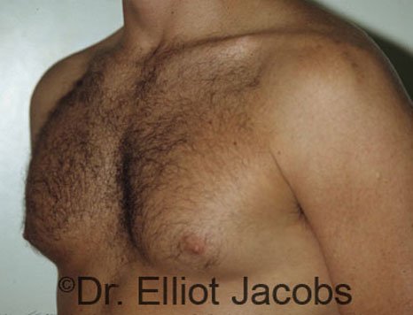 Men's breast, before Gynecomastia treatment in Bodybuilders, oblique view - patient 1