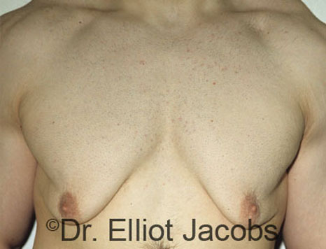 Men's breast, before Gynecomastia treatment in Bodybuilders, front view - patient 2