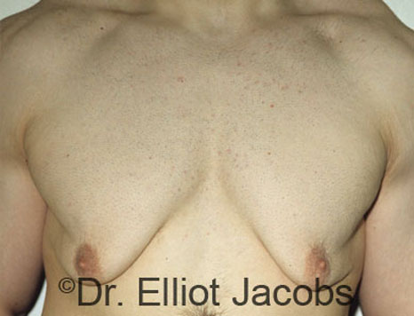 Male breast, before gynecomastia Adolescent treatment, front view, patient 1