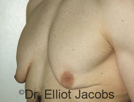 Men's breast, before Gynecomastia treatment in Bodybuilders, oblique view - patient 2