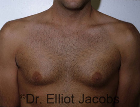 Male breast, before gynecomastia Adolescent treatment, front view, patient 2