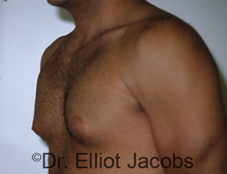 Men's breast, before Gynecomastia treatment in Bodybuilders, oblique view - patient 3