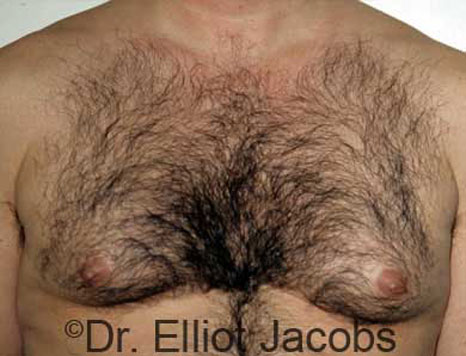 Male breast, before Gynecomastia treatment, front view, patient 11