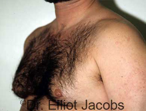 Male breast, before Gynecomastia treatment, l-side oblique view - patient 11