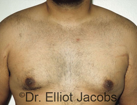 Men's breast, before Gynecomastia treatment in Bodybuilders, front view - patient 4
