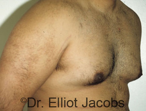 Men's breast, before Gynecomastia treatment in Bodybuilders, oblique view - patient 4