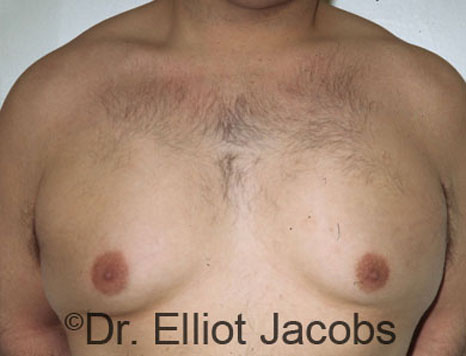 Men's breast, before Gynecomastia treatment in Bodybuilders, front view - patient 5