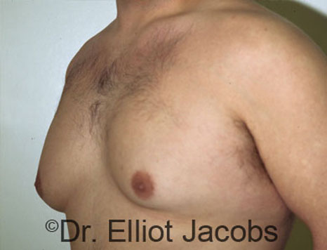 Men's breast, before Gynecomastia treatment in Bodybuilders, oblique view - patient 5
