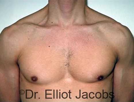 Men's breast, before Gynecomastia treatment in Bodybuilders, front view - patient 6