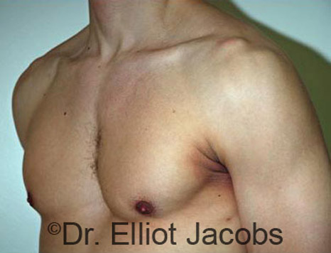 Men's breast, before Gynecomastia treatment in Bodybuilders, oblique view - patient 6