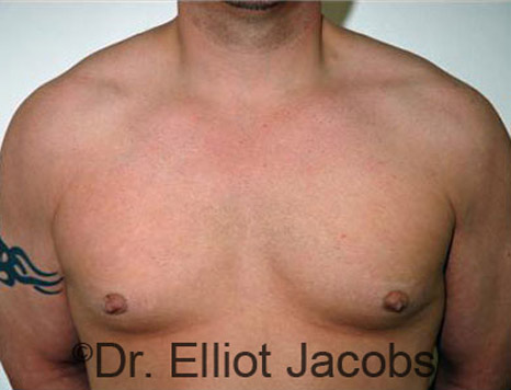 Male breast, before Gynecomastia Surgery for Bodybuilders, front view, patient 2