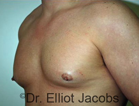 Men's breast, before Gynecomastia treatment in Bodybuilders, oblique view - patient 7