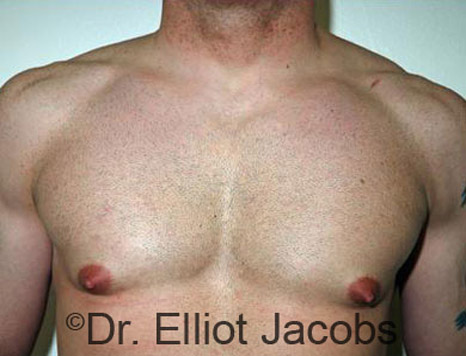 Men's breast, before Gynecomastia treatment in Bodybuilders, front view - patient 8
