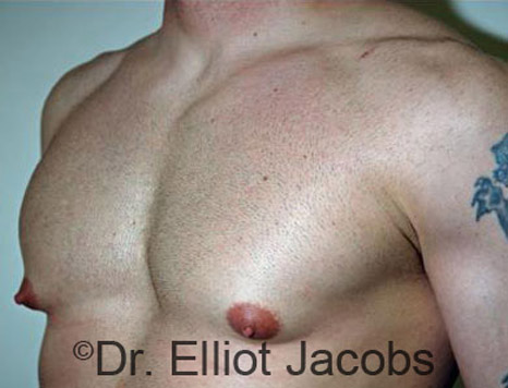 Men's breast, before Gynecomastia treatment in Bodybuilders, oblique view - patient 8