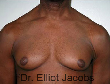 Male breast, before Gynecomastia Surgery for Bodybuilders, front view, patient 1