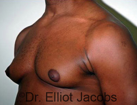 Men's breast, before Gynecomastia treatment in Bodybuilders, oblique view - patient 9