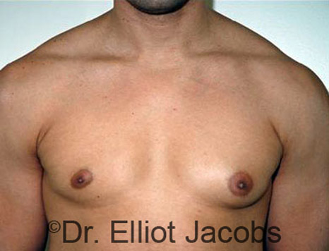 Men's breast, before Gynecomastia treatment in Bodybuilders, front view - patient 10