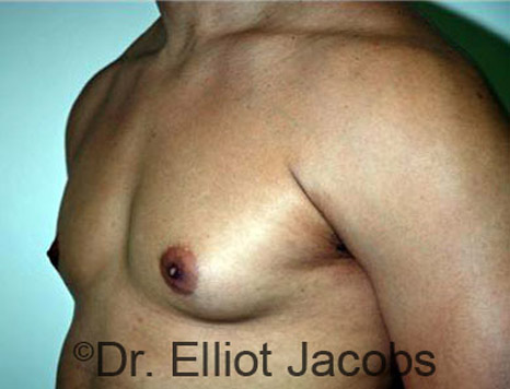 Men's breast, before Gynecomastia treatment in Bodybuilders, oblique view - patient 10