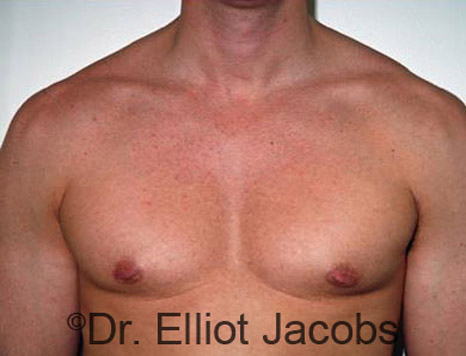 Men's breast, before Gynecomastia treatment in Bodybuilders, front view - patient 11