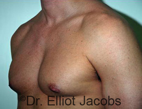 Men's breast, before Gynecomastia treatment in Bodybuilders, oblique view - patient 11
