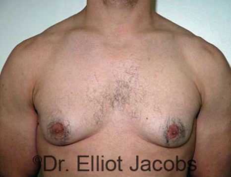 Men's breast, before Gynecomastia treatment in Bodybuilders, front view - patient 12