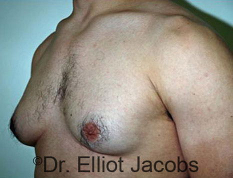 Men's breast, before Gynecomastia treatment in Bodybuilders, oblique view - patient 12