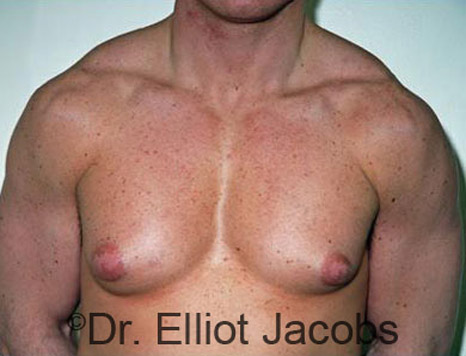Men's breast, before Gynecomastia treatment in Bodybuilders, front view - patient 13