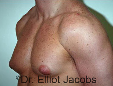Men's breast, before Gynecomastia treatment in Bodybuilders, oblique view - patient 13
