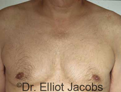 Male breast, before Gynecomastia treatment, front view, patient 12
