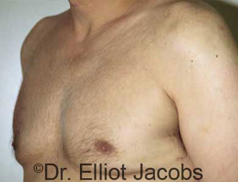 Male breast, before Gynecomastia treatment, l-side oblique view - patient 12