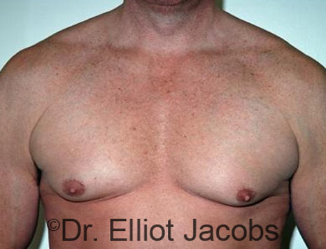 Men's breast, before Gynecomastia treatment in Bodybuilders, front view - patient 14