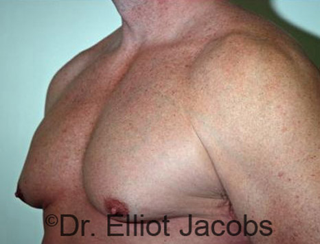 Men's breast, before Gynecomastia treatment in Bodybuilders, oblique view - patient 14