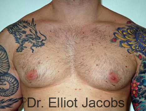 Men's breast, before Gynecomastia treatment in Bodybuilders, front view - patient 15