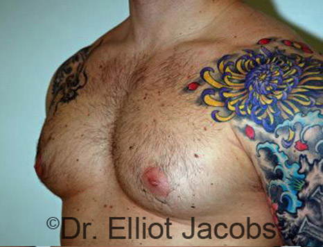 Men's breast, before Gynecomastia treatment in Bodybuilders, oblique view - patient 15