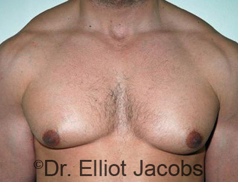Men's breast, before Gynecomastia treatment in Bodybuilders, front view - patient 16