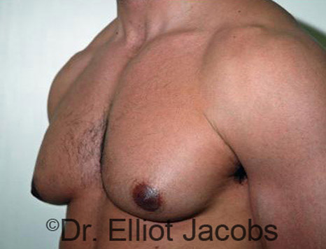 Men's breast, before Gynecomastia treatment in Bodybuilders, oblique view - patient 16